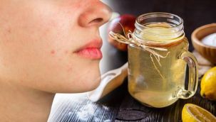 Yüzdeki sivilceler nasıl geçer evde? İltihaplı sivilce nasıl kurutulur?