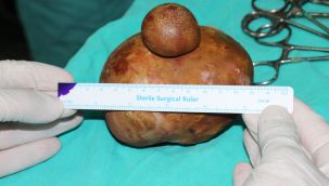 Karaman'da bir hastanın mesanesinden 15x10 ve 4x3 büyüklüğünde 2 taş çıktı  