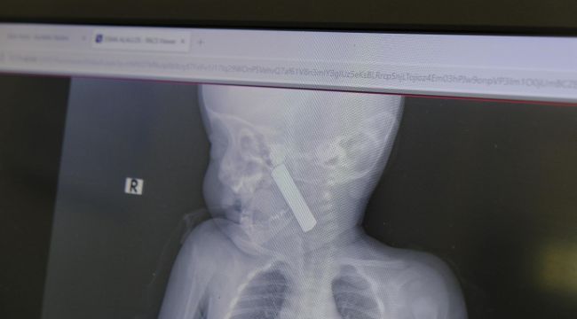 Karaman'da boğazına kumanda pili kaçan bebek ölümden döndü