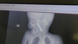 Karaman'da boğazına kumanda pili kaçan bebek ölümden döndü